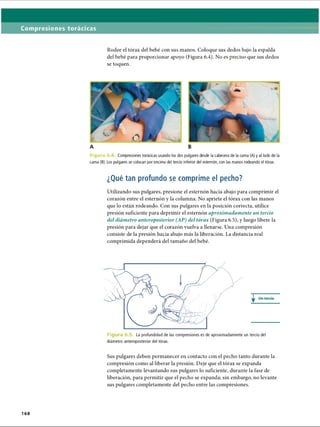 Compresiones torácicas
Rodee el tórax del bebé con sus manos. Coloque sus dedos bajo la espalda
del bebé para proporcionar apoyo (Figura 6.4). No es preciso que sus dedos
se toquen.
F i g u r a 6 Compresiones torácicas usando los dos pulgares desde la cabecera de la cama (A) y al lado de la
cama (B). Los pulgares se colocan por encima del tercio inferior del esternón, con las manos rodeando el tórax.
¿Qué tan profundo se comprime el pecho?
Utilizando sus pulgares, presione el esternón hacia abajo para comprimir el
corazón entre el esternón y la columna. No apriete el tórax con las manos
que lo están rodeando. Con sus pulgares en la posición correcta, utilice
presión suficiente para deprimir el esternón aproximadamente un tercio
del diámetro anteroposterior (AP) del tórax (Figura 6.5), y luego libere la
presión para dejar que el corazón vuelva a llenarse. Una compresión
consiste de la presión hacia abajo más la liberación. La distancia real
comprimida dependerá del tamaño del bebé.
Fi La profundidad de las compresiones es de aproximadamente un tercio del
diámetro anteroposterior del tórax.
Sus pulgares deben permanecer en contacto con el pecho tanto durante la
compresión como al liberar la presión. Deje que el tórax se expanda
completamente levantando sus pulgares lo suficiente, durante la fase de
liberación, para permitir que el pecho se expanda; sin embargo, no levante
sus pulgares completamente del pecho entre las compresiones.
168
ERRNVPHGLFRVRUJ
 
