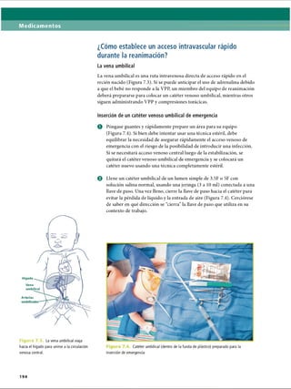 Medicamentos
¿Cómo establece un acceso intravascular rápido
durante la reanimación?
La vena umbilical
La vena umbilical es una ruta intravenosa directa de acceso rápido en el
recién nacido (Figura 7.3). Si se puede anticipar el uso de adrenalina debido
a que el bebé no responde a la VPP, un miembro del equipo de reanimación
deberá prepararse para colocar un catéter venoso umbilical, mientras otros
siguen administrando VPP y compresiones torácicas.
Inserción de un catéter venoso umbilical de emergencia
O Póngase guantes y rápidamente prepare un área para su equipo
(Figura 7.4). Si bien debe intentar usar una técnica estéril, debe
equilibrar la necesidad de asegurar rápidamente el acceso venoso de
emergencia con el riesgo de la posibilidad de introducir una infección.
Si se necesitará acceso venoso central luego de la estabilización, se
quitará el catéter venoso umbilical de emergencia y se colocará un
catéter nuevo usando una técnica completamente estéril.
Hígado
Vena
umbilical
Arterías
Figura 7.3 La vena umbilical viaja
hacia el hígado para unirse a la circulación
venosa central.
© Llene un catéter umbilical de un lumen simple de 3.5F o 5F con
solución salina normal, usando una jeringa (3 a 10 mi) conectada a una
llave de paso. Una vez lleno, cierre la llave de paso hacia el catéter para
evitar la pérdida de líquido y la entrada de aire (Figura 7.4). Cerciórese
de saber en qué dirección se “cierra” la llave de paso que utiliza en su
contexto de trabajo.
Catéter umbilical (dentro de la funda de plástico) preparado para la
inserción de emergencia
194
ERRNVPHGLFRVRUJ
 