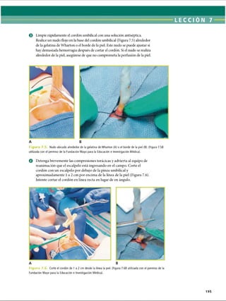 LECCI ÓN 7 -----
© Limpie rápidamente el cordón umbilical con una solución antiséptica.
Realice un nudo flojo en la base del cordón umbilical (Figura 7.5) alrededor
de la gelatina de Wharton o el borde de la piel. Este nudo se puede ajustar si
hay demasiada hemorragia después de cortar el cordón. Si el nudo se realiza
alrededor de la piel, asegúrese de que no comprometa la perfusión de la piel.
A B
Fie Nudo ubicado alrededor de la gelatina de Wharton (A) o el borde de la piel (B). (Figura 7.5B
utilizada con el permiso de la Fundación Mayo para la Educación e Investigación Médica).
© Detenga brevemente las compresiones torácicas y advierta al equipo de
reanimación que el escalpelo está ingresando en el campo. Corte el
cordón con un escalpelo por debajo de la pinza umbilical y
aproximadamente 1a 2 cm por encima de la línea de la piel (Figura 7.6).
Intente cortar el cordón en línea recta en lugar de en ángulo.
A B
Figura 7 ( Corte el cordón de 1 a 2 cm desde la línea la piel. (Figura 7.6B utilizada con el permiso de la
Fundación Mayo para la Educación e Investigación Médica).
195
ERRNVPHGLFRVRUJ
 