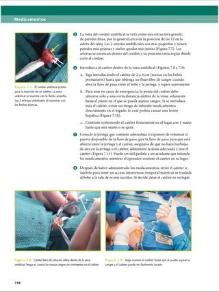 Medicamentos
Figura 7.7 El cordón umbilical pronto
para la inserción de un catéter. La vena
umbilical se muestra con la flecha amarilla.
Las 2 arterias umbilicales se muestran con
las flechas blancas.
o La vena del cordón umbilical se verá como una estructura grande,
de paredes finas, por lo general cerca de la posición de las 12 en la
esfera del reloj. Las 2 arterias umbilicales son más pequeñas y tienen
paredes más gruesas y suelen quedar más juntas (Figura 7.7). Las
arterias se enroscan dentro del cordón y su posición varía según dónde
corte el cordón.
o Introduzca el catéter dentro de la vena umbilical (Figuras 7.8 y 7.9).
a. Siga introduciendo el catéter de 2 a 4 cm (menos en los bebés
prematuros) hasta que obtenga un flujo libre de sangre cuando
abra la llave de paso entre el bebé y la jeringa, y aspire suavemente.
b. Para usar en casos de emergencia, la punta del catéter debe
ubicarse sólo a una corta distancia dentro de la vena; solamente
hasta el punto en el que se pueda aspirar sangre. Si se introduce
más el catéter, existe un riesgo de infundir medicamentos
directamente en el hígado, lo cual podría causar una lesión
hepática (Figura 7.10).
c. Continúe sosteniendo el catéter firmemente en el lugar con 1 mano
hasta que esté sujeto o se quite.
o Conecte la jeringa que contiene adrenalina o expansor de volumen al
puerto disponible de la llave de paso, gire la llave de paso para que esté
abierta entre la jeringa y el catéter, asegúrese de que no haya burbujas
de aire en la jeringa o el catéter, administre la dosis adecuada y lave el
catéter (Figura 7.11). Puede ser útil pedirle a un ayudante que infunda
los medicamentos mientras el operador sostiene el catéter en su lugar.
O Después de haber administrado los medicamentos, retire el catéter o
sujételo para tener un acceso intravenoso temporal mientras se traslada
al bebé a la sala de recién nacidos. Si decide dejar el catéter en su lugar
F i u ra 7 Catéter lleno de solución salina dentro de la vena
umbilical. Tenga en cuenta las marcas negras en centímetros en el catéter.
F i g u ra 7 Haga avanzar el catéter hasta que se pueda aspirar la
sangre y el catéter pueda ser fácilmente lavado.
196
ERRNVPHGLFRVRUJ
 