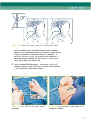 LECCI ON 7
F i g u r a 7 . 1 0 . Colocación correcta (A y B) e incorrecta (C) del catéter de la vena umbilical
durante la estabilización o el traslado, deberá sujetarlo. También se
puede usar una cinta adhesiva transparente para sujetar temporalmente
la línea al abdomen del recién nacido (Figura 7.12). La sutura y el
encintado “tipo poste de meta” son métodos eficaces para sujetar el
catéter para su uso prolongado, pero lleva tiempo y tal vez no sea la
mejor opción durante una reanimación.
o Si retira el catéter, hágalo lentamente y prepárese para controlar el
sangrado ajustando el nudo del cordón, apretando el muñón umbilical
o aplicando presión por encima del ombligo.
F i g u r a 7. Abra la llave de paso hacia el bebé e infunda los
medicamentos.
F i g u r a 7. Sujete temporalmente el catéter umbilical con una
cinta adhesiva transparente.
197
ERRNVPHGLFRVRUJ
 