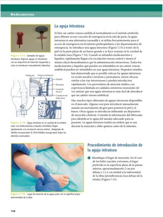 Medicamentos
La aguja intraósea
Si bien un catéter venoso umbilical normalmente es el método preferido
para obtener acceso vascular de emergencia en la sala de parto, la aguja
intraósea es una alternativa razonable y se utiliza frecuentemente para el
acceso de emergencia en el entorno prehospitalario y los departamentos de
emergencia. Se introduce una aguja intraósea (Figura 7.13) a través de la
piel en la parte plana de un hueso grande y se hace avanzar en la cavidad de
la médula ósea (Figura 7.14). Cuando se infunden medicamentos y
líquidos, rápidamente llegan a la circulación venosa central y tienen el
mismo efecto hemodinámico que la administración intravenosa. Todos los
medicamentos y líquidos que pueden ser infundidos en un catéter venoso
umbilical pueden ser infundidos en una aguja intraósea. Pequeños estudios
han demostrado que es posible colocar las agujas intraóseas
en recién nacidos a término y prematuros, tienen eficacia
similar a las vías intravenosas y pueden introducirse
rápidamente. Los proveedores de atención médica con
experiencia limitada en cuidados intensivos neonatales tal
vez sientan que una aguja intraósea es más fácil de introducir
que un catéter venoso umbilical.
Hay muchos tipos diferentes de agujas intraóseas disponibles
en el mercado. Algunas son para introducir manualmente
usando un movimiento de giro para penetrar la piel y el
hueso. Otras agujas se introducen utilizando un dispositivo
de inserción a batería. Consulte la información del fabricante
para identificar la aguja del tamaño adecuado para su
paciente. La aguja intraósea tendrá un estilete que se usa
durante la inserción y debe quitarse antes de la infusión.
derechos reservados).
Trabécula Hueso compacto
Osteón
Periostio
Canal de
Havers
Conducto de
Volkmann
V*
Figura 7.14 Aguja intraósea en la cavidad de la médula
ósea. Los medicamentos y líquidos infundidos llegan
rápidamente a la circulación venosa central. (Adaptado de
Teleflex Incorporated. © 2016 Teleflex Incorporated. Todos los
Figura 7.13. Ejemplos de agujas
intraóseas. Algunas agujas se introducen
con un dispositivo de inserción (izquierda) y
otras se introducen manualmente (derecha).
i ura 7.15. Lugar de inserción de la aguja junto con la superficie plana
anteromedial de la tibia
Procedimiento de introducción de
la aguja intraósea
O Identifique el lugar de inserción. En el caso
de los bebés nacidos a término, el lugar
preferido es la superficie plana de la pierna
inferior, aproximadamente 2 cm por
debajo y 1a 2 cm medial a la tuberosidad
de la tibia (protuberancia ósea debajo de la
rótula) (Figura 7.15).
198
ERRNVPHGLFRVRUJ
 