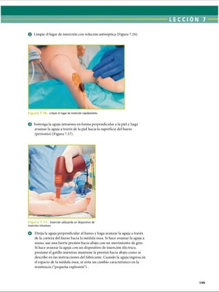LECCI ÓN 7
0 Limpie el lugar de inserción con solución antiséptica (Figura 7.16).
F ic ju r Limpie el lugar de inserción rápidamente.
0 Sostenga la aguja intraósea en forma perpendicular a la piel y haga
avanzar la aguja a través de la piel hacia la superficie del hueso
(periostio) (Figura 7.17).
Figura 7.17. Inserción utilizando un dispositivo de
inserción intraósea
o Dirija la aguja perpendicular al hueso y haga avanzar la aguja a través
de la corteza del hueso hacia la médula ósea. Si hace avanzar la aguja a
mano, use una fuerte presión hacia abajo con un movimiento de giro.
Si hace avanzar la aguja con un dispositivo de inserción eléctrico,
presione el gatillo mientras mantiene la presión hacia abajo como se
describe en las instrucciones del fabricante. Cuando la aguja ingresa en
el espacio de la médula ósea, se nota un cambio característico en la
resistencia (“pequeña explosión”) .
199
ERRNVPHGLFRVRUJ
 