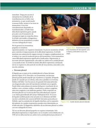 LECCI ÓN 10
inmediato. Tenga precaución al
interpretar los resultados de la
transiluminación en bebés muy
prematuros, ya que su piel puede
ocasionar brillo, incluso si no tiene un
neumotorax. Si no está
inmediatamente disponible un
transiluminador y el bebé tiene
dificultad respiratoria grave, puede
proceder con el tratamiento de
emergencia según su sospecha clínica.
Si el bebé está estable, el diagnóstico
definitivo de un neumotorax se realiza
con una radiografía de tórax.
Por lo general, los neumotorax
pequeños se resuelven
espontáneamente y no requieren tratamiento. Es preciso monitorear al bebé
para controlar el empeoramiento de la dificultad respiratoria. Si el bebé
mantiene una saturación de oxígeno normal, el oxígeno complementario no
se indica y no causa la resolución precoz del neumotorax. Si un neumotorax
causa dificultad respiratoria significativa, bradicardia o hipotensión, es
necesario aliviarlo urgentemente colocando un catéter en la cavidad pleural
y evacuando el aire. Si el bebé ha tenido dificultad respiratoria continuada,
tal vez se requiera la colocación de un tubo de toracostomía conectado a una
succión continua.
F i g u r a 10.1 Transiluminación positiva
de un neumotorax del lado izquierdo. La luz
se dispersa y brilla dentro de una zona
amplia.
• Derrame pleural
El líquido que se junta en la cavidad pleural se llama derrame
pleural (Figura 10.3). Parecido a un neumotorax, un derrame
pleural grande puede impedir que el pulmón se expanda. El líquido
puede ser causado por un edema, infección o pérdida en el sistema
linfático del bebé. Con frecuencia, los grandes derrames pleurales
son diagnosticados antes del nacimiento mediante una ecografía.
Puede haber antecedentes de anemia fetal grave, transfusión de un
mellizo a otro, arritmia cardíaca, insuficiencia cardíaca congènita,
infección congènita o un síndrome genético. Debe sospechar un
derrame pleural si el recién nacido tiene dificultad para respirar
y un edema generalizado del cuerpo (hidropesía fetal). El exceso
de líquido también puede estar presente en el abdomen del bebé
(ascitis) y alrededor del corazón del bebé (derrames pericárdicos).
Debido a que la acumulación de líquido interfiere con la expansión
del pulmón, los sonidos respiratorios pueden estar disminuidos en
el lado afectado. El diagnóstico definitivo de un derrame pleural se realiza
con una radiografía de tórax.
Tal vez un derrame pleural pequeño no requiera tratamiento. Si la
dificultad respiratoria es importante y no se resuelve con la intubación y la
VPP, tal vez deba insertar un catéter en la cavidad pleural para drenar el
F i g u r a 10.} Grandes derrames pleurales bilaterales
247
ERRNVPHGLFRVRUJ
 