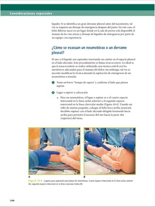 Consideraciones especiales
líquido. Si se identifica un gran derrame pleural antes del nacimiento, tal
vez se requiera un drenaje de emergencia después del parto. En este caso, el
bebé debería nacer en un lugar donde en la sala de partos esté disponible el
manejo de las vías aéreas y drenaje de líquidos de emergencia por parte de
un equipo con experiencia.
¿Cómo se evacúan un neumotorax o un derrame
pleural?
El aire o el líquido son aspirados insertando un catéter en el espacio pleural
en el lado afectado. Este procedimiento se llama toracocentesis. Lo ideal es
que la toracocentesis se realice utilizando una técnica estéril con los
anestésicos adecuados para el manejo del dolor; sin embargo, tal vez se
necesite modificar la técnica durante la aspiración de emergencia de un
neumotorax a tensión.
o Tome un breve “tiempo de espera” y confirme el lado que planea
aspirar.
Q Lugar a aspirar y colocación
a. Para un neumotorax, el lugar a aspirar es o el cuarto espacio
intercostal en la línea axilar anterior o el segundo espacio
intercostal en la línea clavicular media (Figura 10.4). Usando un
rollo de mantas pequeño, coloque al bebé boca arriba (posición
decúbito supina) con el lado afectado dirigido levemente hacia
arriba para permitir el ascenso del aire hacia la parte alta
(superior) del tórax.
Figura 10.4 Lugares para aspiración percutánea de neumotorax. Cuarto espacio intercostal en la línea axilar anterior
(A), segundo espacio intercostal en la línea clavicular media (B).
248
ERRNVPHGLFRVRUJ
 