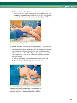 b. Para un derrame pleural, el lugar a aspirar es el quinto o sexto
espacio intercostal junto a la línea axilar posterior. Coloque al bebé
boca arriba (posición decúbito supina) para permitir que el líquido
se acumule en la parte baja (posterior) del tórax (Figura 10.5).
F ig u ra 10.5. Lugar de aspiración de un derrame pleural
© Prepare el lugar de inserción con antisépticos tópicos y toallas estériles.
o Inserte un dispositivo de catéter percutáneo de calibre 18 o 20 en forma
perpendicular al pecho y justo por encima de la costilla. La aguja se
coloca por encima de la costilla en lugar de hacerlo justo debajo de la
costilla para evitar la perforación de los vasos sanguíneos ubicados
bajo cada costilla.
a. Para un neumotorax, dirija el catéter hacia arriba (Figura 10.6).
b. Para un derrame pleural, dirija el catéter hacia abajo.
Figura 10.6. Aspiración de un neumotorax. La aguja se introduce por
encima de la costilla y dirigida hacia arriba. Nota: El lugar de aspiración no
está cubierto con toallas estériles a efectos fotográficos, sin embargo, la
técnica estéril modificada es aceptable para una aspiración de emergencia.
ERRNVPHGLFRVRUJ
 