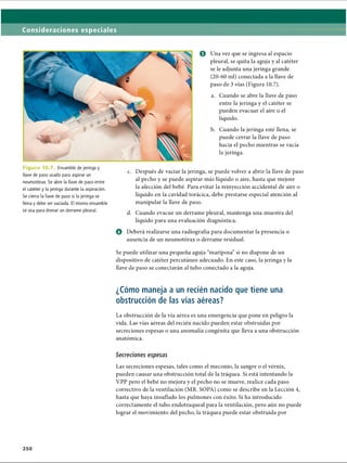 Consideraciones especiales
© Una vez que se ingresa al espacio
pleural, se quita la aguja y al catéter
se le adjunta una jeringa grande
(20-60 mi) conectada a la llave de
paso de 3 vías (Figura 10.7).
a. Cuando se abre la llave de paso
entre la jeringa y el catéter se
pueden evacuar el aire o el
líquido.
b. Cuando la jeringa esté llena, se
puede cerrar la llave de paso
hacia el pecho mientras se vacía
la jeringa.
Figura 10.7. Ensamble de jeringa y
llave de paso usado para aspirar un
neumotorax. Se abre la llave de paso entre
el catéter y la jeringa durante la aspiración.
Se cierra la llave de paso si la jeringa se
llena y debe ser vaciada. El mismo ensamble
se usa para drenar un derrame pleural.
c. Después de vaciar la jeringa, se puede volver a abrir la llave de paso
al pecho y se puede aspirar más líquido o aire, hasta que mejore
la afección del bebé. Para evitar la reinyección accidental de aire o
líquido en la cavidad torácica, debe prestarse especial atención al
manipular la llave de paso.
d. Cuando evacúe un derrame pleural, mantenga una muestra del
líquido para una evaluación diagnóstica.
o Deberá realizarse una radiografía para documentar la presencia o
ausencia de un neumotorax o derrame residual.
Se puede utilizar una pequeña aguja “mariposa” si no dispone de un
dispositivo de catéter percutáneo adecuado. En este caso, la jeringa y la
llave de paso se conectarán al tubo conectado a la aguja.
¿Cómo maneja a un recién nacido que tiene una
obstrucción de las vías aéreas?
La obstrucción de la vía aérea es una emergencia que pone en peligro la
vida. Las vías aéreas del recién nacido pueden estar obstruidas por
secreciones espesas o una anomalía congènita que lleva a una obstrucción
anatómica.
Secreciones espesas
Las secreciones espesas, tales como el meconio, la sangre o el vérnix,
pueden causar una obstrucción total de la tráquea. Si está intentando la
VPP pero el bebé no mejora y el pecho no se mueve, realice cada paso
correctivo de la ventilación (MR. SOPA) como se describe en la Lección 4,
hasta que haya insuflado los pulmones con éxito. Si ha introducido
correctamente el tubo endotraqueal para la ventilación, pero aún no puede
lograr el movimiento del pecho, la tráquea puede estar obstruida por
250
ERRNVPHGLFRVRUJ
 