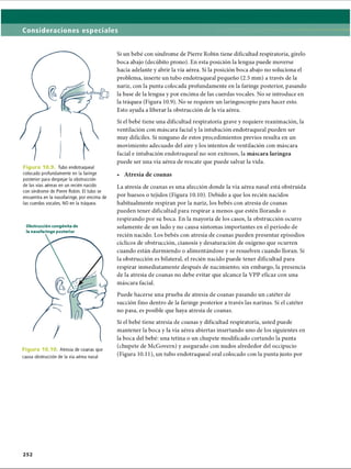 Consideraciones especiales
Figura 10.9. Tubo endotraqueal
colocado profundamente en la faringe
posterior para despejar la obstrucción
de las vías aéreas en un recién nacido
con síndrome de Pierre Robín. El tubo se
encuentra en la nasofaringe, por encima de
las cuerdas vocales, NO en la tráquea.
Obstrucción congènita de
la nasofaringe posterior
F ig u ra 10.10. Atresia de coanas que
causa obstrucción de la vía aérea nasal
Si un bebé con síndrome de Pierre Robin tiene dificultad respiratoria, gírelo
boca abajo (decúbito prono). En esta posición la lengua puede moverse
hacia adelante y abrir la vía aérea. Si la posición boca abajo no soluciona el
problema, inserte un tubo endotraqueal pequeño (2.5 mm) a través de la
nariz, con la punta colocada profundamente en la faringe posterior, pasando
la base de la lengua y por encima de las cuerdas vocales. No se introduce en
la tráquea (Figura 10.9). No se requiere un laringoscopio para hacer esto.
Esto ayuda a liberar la obstrucción de la vía aérea.
Si el bebé tiene una dificultad respiratoria grave y requiere reanimación, la
ventilación con máscara facial y la intubación endotraqueal pueden ser
muy difíciles. Si ninguno de estos procedimientos previos resulta en un
movimiento adecuado del aire y los intentos de ventilación con máscara
facial e intubación endotraqueal no son exitosos, la máscara laríngea
puede ser una vía aérea de rescate que puede salvar la vida.
• Atresia de coanas
La atresia de coanas es una afección donde la vía aérea nasal está obstruida
por huesos o tejidos (Figura 10.10). Debido a que los recién nacidos
habitualmente respiran por la nariz, los bebés con atresia de coanas
pueden tener dificultad para respirar a menos que estén llorando o
respirando por su boca. En la mayoría de los casos, la obstrucción ocurre
solamente de un lado y no causa síntomas importantes en el período de
recién nacido. Los bebés con atresia de coanas pueden presentar episodios
cíclicos de obstrucción, cianosis y desaturación de oxígeno que ocurren
cuando están durmiendo o alimentándose y se resuelven cuando lloran. Si
la obstrucción es bilateral, el recién nacido puede tener dificultad para
respirar inmediatamente después de nacimiento; sin embargo, la presencia
de la atresia de coanas no debe evitar que alcance la VPP eficaz con una
máscara facial.
Puede hacerse una prueba de atresia de coanas pasando un catéter de
succión fino dentro de la faringe posterior a través las narinas. Si el catéter
no pasa, es posible que haya atresia de coanas.
Si el bebé tiene atresia de coanas y dificultad respiratoria, usted puede
mantener la boca y la vía aérea abiertas insertando uno de los siguientes en
la boca del bebé: una tetina o un chupete modificado cortando la punta
(chupete de McGovern) y asegurado con nudos alrededor del occipucio
(Figura 10.11), un tubo endotraqueal oral colocado con la punta justo por
ERRNVPHGLFRVRUJ
 