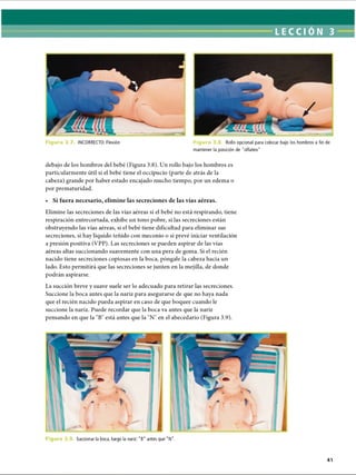 Figura 3.7 INCORRECTO: Flexión Figura 3.8, Rollo opcional para colocar bajo los hombros a fin de
mantener la posición de '‘olfateo’'
debajo de los hombros del bebé (Figura 3.8). Un rollo bajo los hombros es
particularmente útil si el bebé tiene el occipucio (parte de atrás de la
cabeza) grande por haber estado encajado mucho tiempo, por un edema o
por prematuridad.
• Si fuera necesario, elimine las secreciones de las vías aéreas.
Elimine las secreciones de las vías aéreas si el bebé no está respirando, tiene
respiración entrecortada, exhibe un tono pobre, si las secreciones están
obstruyendo las vías aéreas, si el bebé tiene dificultad para eliminar sus
secreciones, si hay líquido teñido con meconio o si prevé iniciar ventilación
a presión positiva (VPP). Las secreciones se pueden aspirar de las vías
aéreas altas succionando suavemente con una pera de goma. Si el recién
nacido tiene secreciones copiosas en la boca, póngale la cabeza hacia un
lado. Esto permitirá que las secreciones se junten en la mejilla, de donde
podrán aspirarse.
La succión breve y suave suele ser lo adecuado para retirar las secreciones.
Succione la boca antes que la nariz para asegurarse de que no haya nada
que el recién nacido pueda aspirar en caso de que boquee cuando le
succione la nariz. Puede recordar que la boca va antes que la nariz
pensando en que la B está antes que la N en el abecedario (Figura 3.9).
Figura 3.9. Succionar la boca, luego la nariz: B antes que N.
41
ERRNVPHGLFRVRUJ
 