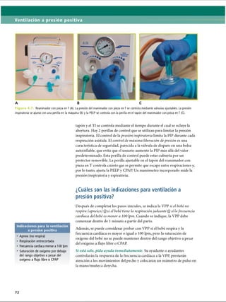 Ventilación a presión positiva
F i g u r a 4 . 7 Reanimador con pieza en T (A). La presión del reanimador con pieza en T se controla mediante válvulas ajustables. La presión
inspiratoria se ajusta con una perilla en la máquina (B) y la PEEP se controla con la perilla en el tapón del reanimador con pieza en T (C).
tapón y el TI se controla mediante el tiempo durante el cual se ocluye la
abertura. Hay 2 perillas de control que se utilizan para limitar la presión
inspiratoria. El control de la presión inspiratoria limita la PIP durante cada
respiración asistida. El control de máxima liberación de presión es una
característica de seguridad, parecida a la válvula de disparo en una bolsa
autoinflable, que evita que el usuario aumente la PIP más allá del valor
predeterminado. Esta perilla de control puede estar cubierta por un
protector removible. La perilla ajustable en el tapón del reanimador con
pieza en T controla cuánto gas se permite que escape entre respiraciones y,
por lo tanto, ajusta la PEEP y CPAP. Un manómetro incorporado mide la
presión inspiratoria y espiratoria.
¿Cuáles son las indicaciones para ventilación a
presión positiva?
Indicaciones para la ventilación
a presión positiva
• Apnea (no respira)
• Respiración entrecortada
• Frecuencia cardíaca menor a 100 Ipm
• Saturación de oxígeno por debajo
del rango objetivo a pesar del
oxígeno a flujo libre o CPAP
Después de completar los pasos iniciales, se indica la VPP si el bebé no
respira (apneico) O si el bebé tiene la respiraciónjadeante O si lafrecuencia
cardíaca del bebé es menor a 100 Ipm. Cuando se indique, la VPP debe
comenzar dentro de 1 minuto a partir del parto.
Además, se puede considerar probar con VPP si el bebé respira y la
frecuencia cardíaca es mayor o igual a 100 Ipm, pero la saturación de
oxígeno del bebé no se puede mantener dentro del rango objetivo a pesar
del oxígeno a flujo libre o CPAP.
Si está solo, pida ayuda inmediatamente. Su ayudante o ayudantes
controlarán la respuesta de la frecuencia cardíaca a la VPP, prestarán
atención a los movimientos del pecho y colocarán un oxímetro de pulso en
la mano/muñeca derecha.
ERRNVPHGLFRVRUJ
 