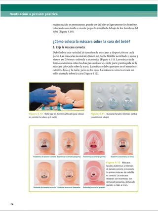 Ventilación a presión positiva
recién nacido es prominente, puede ser útil elevar ligeramente los hombros
colocando una toalla o manta pequeña enrollada debajo de los hombros del
bebé (Figura 4.10).
¿Cómo coloca la máscara sobre la cara del bebé?
1. Elija la máscara correcta.
Debe haber una variedad de tamaños de máscaras a disposición en cada
parto. Las máscaras neonatales tienen un borde flexible acolchado o suave y
vienen en 2 formas: redonda y anatómica (Figura 4.11). Las máscaras de
forma anatómica están hechas para colocarse con la parte puntiaguda de la
máscara colocada sobre la nariz. La máscara debe apoyarse en el mentón y
cubrir la boca y la nariz, pero no los ojos. La máscara correcta creará un
sello ajustado sobre la cara (Figura 4.12).
Figuro 4.10. Rollo bajo los hombros utilizado para colocar
en posición la cabeza y el cuello
Máscaras faciales redondas (arriba)
y anatómicas (abajo)
Anatómica de tamaño correcto Anatómica incorrecta (pequeña) Anatómica incorrecta (grande) Anatómica incorrecta (al revés)
Redonda de tamaño correcto Redonda incorrecta (pequeña) Redonda incorrecta (grande)
Figura 4.12. Máscaras
faciales anatómicas y redondas
de tamaño correcto e incorrecto.
La primera máscara de cada fila
es correcta. Las máscaras
restantes son incorrectas. Son
demasiado pequeñas, demasiado
grandes o están al revés.
ERRNVPHGLFRVRUJ
 
