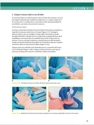 LECCI ON 4
2. Coloque la máscara sobre la cara del bebé.
Es necesario lograr un sello hermético entre el borde de la máscara y la cara
para lograr la presión que insuflará los pulmones con cualquier dispositivo
de reanimación. La ventilación no será exitosa si hay una gran pérdida de
aire debido a una mala colocación de la máscara.
Técnica de una mano:
Comience colocando el mentón en la parte inferior de la máscara anatómica y
luego lleve la máscara sobre la boca y la nariz (Figura 4.13). Sostenga la
máscara sobre la cara con el pulgar y el dedo índice formando un círculo
alrededor del borde. Coloque los otros 3 dedos bajo en ángulo del hueso de la
mandíbula y suavemente eleve la mandíbula hacia arriba en dirección a la
máscara. Una vez colocada la máscara, se puede formar un sello hermético
usando una presión uniforme hacia abajo, en el borde de la máscara, mientras
sostiene la cabeza en la posición de olfateo (Figura 4.14A).
Algunas máscaras redondas están diseñadas para ser sostenidas del tronco
en vez del borde (Figura 4.14B). Si aplica presión al borde en este tipo de
máscaras, la forma de la máscara se deforma y habrá una pérdida.
A B
Figu (A) Coloque la máscara en el mentón. (B) Lleve la máscara sobre la boca y nariz.
F ig Mantenimiento del sello usando una máscara anatómica (A) o una máscara redonda (B) con la técnica de una mano.
ERRNVPHGLFRVRUJ
 