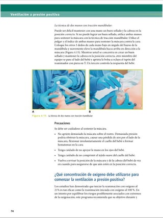 Ventilación a presión positiva
La técnica de dos manos con tracción mandibular:
Puede ser difícil mantener con una mano un buen sellado y la cabeza en la
posición correcta. Si no puede lograr un buen sellado, utilice ambas manos
para sostener la máscara con la técnica de tracción mandibular. Utilice el
pulgar y el índice de ambas manos para sostener la máscara contra la cara.
Coloque los otros 3 dedos de cada mano bajo en ángulo del hueso de la
mandíbula y suavemente eleve la mandíbula hacia arriba en dirección a la
máscara (Figura 4.15). Mientras usted se concentra en crear un buen
sellado y mantener la cabeza en la posición correcta, otro miembro del
equipo se para al lado del bebé y aprieta la bolsa u ocluye el tapón del
reanimador con pieza en T. Un tercero controla la respuesta del bebé.
F i g u r a 4 . 1 5 . La técnica de dos manos con tracción mandibular
Precauciones
Se debe ser cuidadoso al sostener la máscara.
• No apriete demasiado la máscara sobre el rostro. Demasiada presión
podría obstruir la máscara, causar una pérdida de aire por el lado de la
máscara, flexionar involuntariamente el cuello del bebé o formar
hematomas en la cara.
• Tenga cuidado de no apoyar la mano en los ojos del bebé.
• Tenga cuidado de no comprimir el tejido suave del cuello del bebé.
• Vuelva a revisar la posición de la máscara y de la cabeza del bebé de vez
en cuando para asegurarse de que aún estén en la posición correcta.
¿Qué concentración de oxígeno debe utilizarse para
comenzar la ventilación a presión positiva?
Los estudios han demostrado que iniciar la reanimación con oxígeno al
21% es tan eficaz como la reanimación iniciada con oxígeno al 100 %. En
un intento por equilibrar los riesgos posiblemente asociados con extremos
de la oxigenación, este programa recomienda que su objetivo durante y
ERRNVPHGLFRVRUJ
 