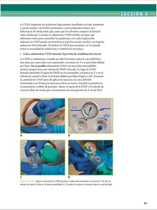 La CPAP mantiene los pulmones ligeramente insuflados en todo momento
y puede ayudar a los bebés prematuros cuyos pulmones tienen una
deficiencia de surfactante que causa que los alvéolos colapsen al final de
cada exhalación. Cuando se administra CPAP, el bebé no tiene que
esforzarse tanto para reinsuflar los pulmones con cada respiración.
Además, la CPAP puede ser beneficiosa para los recién nacidos con líquido
pulmonar fetal retenido. Al utilizar la CPAP precozmente, tal vez pueda
evitar la necesidad de intubación y ventilación mecánica.
• Cómo administrar CPAP durante elperíodo de estabilización inicial
La CPAP se administra creando un sello hermético entre la cara del bebé y
una máscara conectada a un reanimador con pieza en T o a una bolsa inflada
por flujo. No es posible administrar CPAP con una bolsa autoinflable,
incluso aunque haya una válvula de PEEP colocada. Se logra la CPAP
deseada ajustando el tapón de PEEP en el reanimador con pieza en T o en la
válvula de control a flujo en la bolsa inflada por flujo (Figura 4.20). Examine
la cantidad de CPAP antes de aplicar la máscara a la cara del bebé
sosteniendo con firmeza la máscara contra su mano y leyendo la presión en
el manómetro (calibre de presión). Ajuste el tapón de la PEEP o la válvula de
control a flujo de modo que el manómetro lea una presión de 5 cm de H20.
F i g u r a 4.20. Ajuste la presión de la CPAP girando el tapón del reanimador con pieza en T (A, B) o la
válvula de control a flujo en la bolsa autoinflable (C, D) antes de colocar la máscara sobre la cara del bebé.
ERRNVPHGLFRVRUJ
 