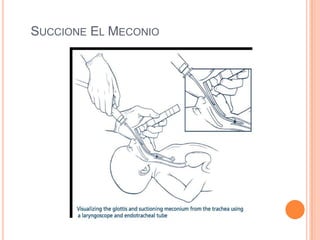 FC  > 60 detenerlascompresionestoracicas.