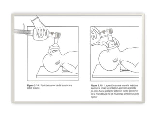 Meconio  Presente y Recién Nacido vigorosoSi el esfuerzo respiratorio es bueno yTono muscular adecuado ,yFc mayor de 100 por min. Proceda: Usar Perilla de succión  o sonda para limpiar boca y nariz.