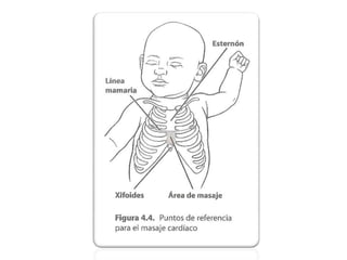 Reanimador con pieza en T