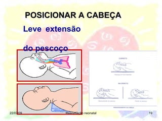 POSICIONAR A CABEÇA 22/07/09 Reanimação neonatal Leve extensão  do pescoço 