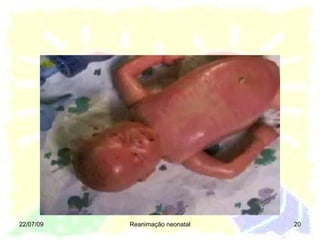 22/07/09 Reanimação neonatal 