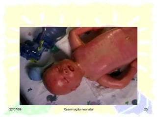 22/07/09 Reanimação neonatal 