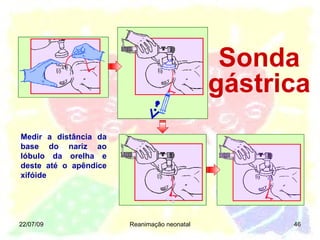 22/07/09 Reanimação neonatal Sonda gástrica Medir a distância da base do nariz ao lóbulo da orelha e deste até o apêndice xifóide 