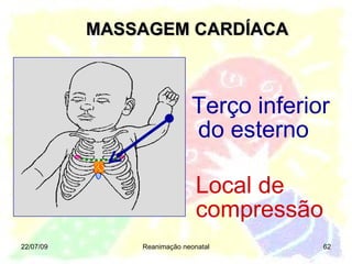 MASSAGEM CARDÍACA 22/07/09 Reanimação neonatal Local de compressão Terço inferior do esterno 