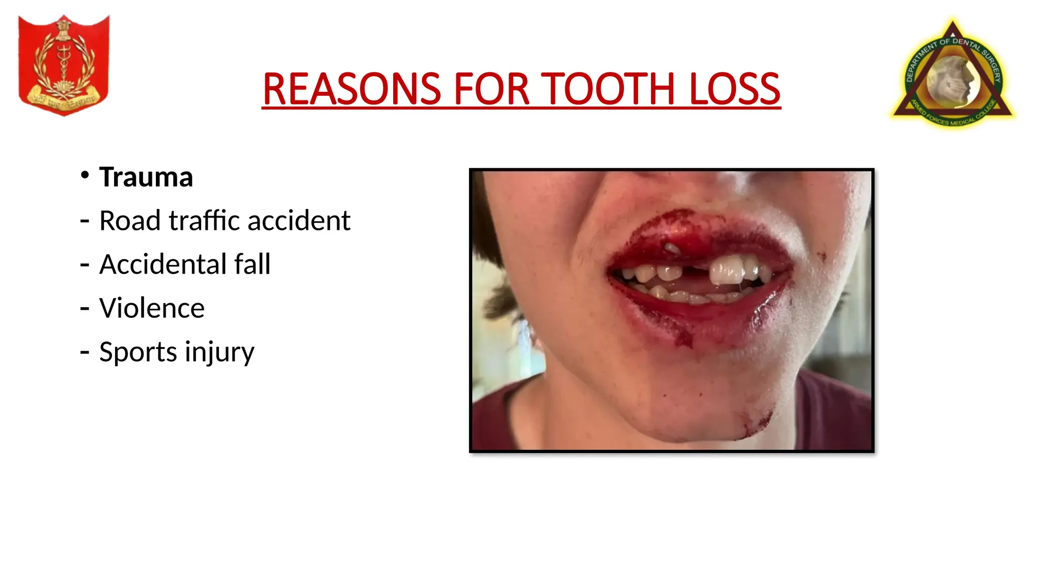 paper presentation reasons for tooth loss.pptx