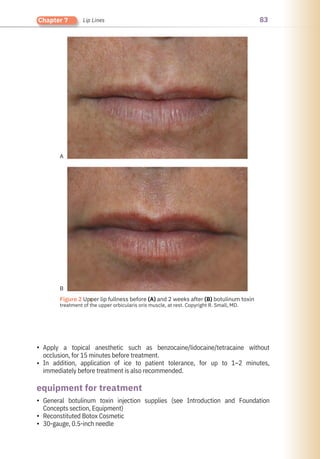 83
Chapter 7 Lip Lines
•
•
•
•
•
Apply a topical anesthetic such as benzocaine/lidocaine/tetracaine without
occlusion, for 15 minutes before treatment.
In addition, application of ice to patient tolerance, for up to 1–2 minutes,
immediately before treatment is also recommended.
General botulinum toxin injection supplies (see Introduction and Foundation
Concepts section, Equipment)
Reconstituted Botox Cosmetic
30-gauge, 0.5-inch needle
equipment for treatment
●
Figure 2 Upper lip fullness before (A) and 2 weeks after (B) botulinum toxin
treatment of the upper orbicularis oris muscle, at rest. Copyright R. Small, MD.
A
B
 