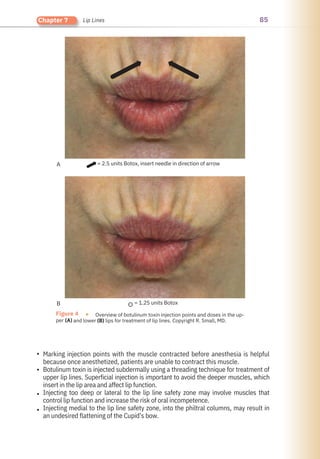 85
Chapter 7 Lip Lines
= 1.25 units Botox
= 2.5 units Botox, insert needle in direction of arrow
A
B
Figure 4 ●
per
Overview of botulinum toxin injection points and doses in the up-
and lower (B) lips for treatment of lip lines. Copyright R. Small, MD.
(A)
•
•
•
•
Marking injection points with the muscle contracted before anesthesia is helpful
because once anesthetized, patients are unable to contract this muscle.
Botulinum toxin is injected subdermally using a threading technique for treatment of
upper lip lines. Superficial injection is important to avoid the deeper muscles, which
insert in the lip area and affect lip function.
Injecting too deep or lateral to the lip line safety zone may involve muscles that
control lip function and increase the risk of oral incompetence.
Injecting medial to the lip line safety zone, into the philtral columns, may result in
an undesired flattening of the Cupid’s bow.
 
