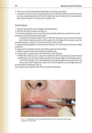 86 Botulinum toxin Procedures
•
•
Take care to inject equal doses bilaterally to avoid lip asymmetry.
In patients who have never had botulinum toxin treatment of the lips, and for provid-
ers who are getting started with lip line botulinum toxin treatments, it is advisable to
treat only the upper or the lower lip in a given visit.
1. Position the patient at a 60-degree reclined position.
2. Identify the lip line safety zone (Fig. 3).
3. Locate the orbicularis oris muscle by instructing the patient to contract the muscle
using one of the facial expressions above.
4. Identify the injection points (Fig. 4). With the orbicularis oris muscle contracted,
mark the two injection points on the upper lip in the ridges of the muscle, near the
vermillion border, at least 1 cm from the corners of the mouth.
5. Apply topical anesthetic to the treatment area for 10–15 minutes and remove before
treatment.
6. Apply ice for anesthesia to the side of the upper lip to be treated.
7. Prepare injection sites with alcohol and allow to dry.
8. The provider is positioned on the side that is to be injected.
9. While the mouth is at rest, insert the needle into the first injection point and thread
superficially, such that the needle tip ends at the lateral edge of the philtral column.
Use the first finger of the noninjecting hand to gently palpate the needle tip in the
tissue and confirm placement. Inject 2.5 units with gentle, even plunger pressure
as the needle is withdrawn (Fig. 5).
10. Compress the injection sites firmly to relieve discomfort.
technique
●
Figure 5 Orbicularis oris muscle botulinum toxin injection technique.
Copyright R. Small, MD.
 