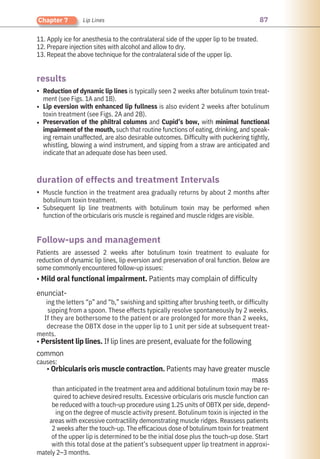 87
Chapter 7 Lip Lines
11. Apply ice for anesthesia to the contralateral side of the upper lip to be treated.
12. Prepare injection sites with alcohol and allow to dry.
13. Repeat the above technique for the contralateral side of the upper lip.
Reduction of dynamic lip lines is typically seen 2 weeks after botulinum toxin treat-
ment (see Figs. 1A and 1B).
Lip eversion with enhanced lip fullness is also evident 2 weeks after botulinum
toxin treatment (see Figs. 2A and 2B).
Preservation of the philtral columns and Cupid’s bow, with minimal functional
impairment of the mouth, such that routine functions of eating, drinking, and speak-
ing remain unaffected, are also desirable outcomes. Difficulty with puckering tightly,
whistling, blowing a wind instrument, and sipping from a straw are anticipated and
indicate that an adequate dose has been used.
Patients are assessed 2 weeks after botulinum toxin treatment to evaluate for
reduction of dynamic lip lines, lip eversion and preservation of oral function. Below are
some commonly encountered follow-up issues:
• Mild oral functional impairment. Patients may complain of difficulty
enunciat-
ing the letters “p” and “b,” swishing and spitting after brushing teeth, or difficulty
sipping from a spoon. These effects typically resolve spontaneously by 2 weeks.
If they are bothersome to the patient or are prolonged for more than 2 weeks,
decrease the OBTX dose in the upper lip to 1 unit per side at subsequent treat-
ments.
• Persistent lip lines. If lip lines are present, evaluate for the following
common
causes:
• Orbicularis oris muscle contraction. Patients may have greater muscle
mass
than anticipated in the treatment area and additional botulinum toxin may be re-
quired to achieve desired results. Excessive orbicularis oris muscle function can
be reduced with a touch-up procedure using 1.25 units of OBTX per side, depend-
ing on the degree of muscle activity present. Botulinum toxin is injected in the
areas with excessive contractility demonstrating muscle ridges. Reassess patients
2 weeks after the touch-up. The efficacious dose of botulinum toxin for treatment
of the upper lip is determined to be the initial dose plus the touch-up dose. Start
with this total dose at the patient’s subsequent upper lip treatment in approxi-
mately 2–3 months.
Muscle function in the treatment area gradually returns by about 2 months after
botulinum toxin treatment.
Subsequent lip line treatments with botulinum toxin may be performed when
function of the orbicularis oris muscle is regained and muscle ridges are visible.
results
Follow-ups and management
duration of effects and treatment Intervals
•
•
•
•
•
 