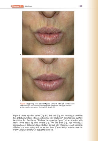 89
Chapter 7 Lip Lines
●
Figure 6 Upper lip lines before (A) and 1 month after (B) combination
treatment with botulinum toxin and dermal filler above the upper lip, with
active muscle contraction. Copyright R. Small, MD.
A
B
Figure 6 shows a patient before (Fig. 6A) and after (Fig. 6B) receiving a combina-
tion of botulinum toxin (Botox) and dermal filler (Radiesse® manufactured by Merz
Aesthetics, Inc, San Mateo, CA) above the upper lip. Figure 7 shows a patient with
more severe radial lip lines before (Fig. 7A) and after (Fig. 7B) receiving a
combination of botulinum toxin (Botox), dermal filler (Radiesse), and fractional
ablative skin resurfacing with an erbium laser (DermaSculpt manufactured by
HOYA ConBio, Fremont, CA) above the upper lip.
 