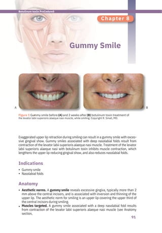 91
A B
Chapter 8
Gummy Smile
Gummy smile
Nasolabial folds
Exaggerated upper lip retraction during smiling can result in a gummy smile with exces-
sive gingival show. Gummy smiles associated with deep nasolabial folds result from
contraction of the levator labii superioris alaeque nasi muscle. Treatment of the levator
labii superioris alaeque nasi with botulinum toxin inhibits muscle contraction, which
lengthens the upper lip reducing gingival show, and also reduces nasolabial folds.
Aesthetic norms. A gummy smile reveals excessive gingiva, typically more than 2
mm above the central incisors, and is associated with inversion and thinning of the
upper lip. The aesthetic norm for smiling is an upper lip covering the upper third of
the central incisors during smiling.
Muscles targeted. A gummy smile associated with a deep nasolabial fold results
from contraction of the levator labii superioris alaeque nasi muscle (see Anatomy
section,
Anatomy
Indications
•
•
•
•
●
Figure 1 Gummy smile before (A) and 2 weeks after (B) botulinum toxin treatment of
the levator labii superioris alaeque nasi muscle, while smiling. Copyright R. Small, MD.
BotulInum toxIn ProCedureS
 