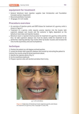 93
Chapter 8 Gummy Smile
technique
Procedure overview
equipment for treatment
•
•
•
•
•
•
•
1. Position the patient at a 60-degree reclined position.
2. Locate the levator labii superioris alaeque nasi muscle by instructing the patient to
contract the muscle using the facial expression above.
3. Identify the injection points (Fig. 2).
4. Ice for anesthesia (optional).
5. Prepare injection sites with alcohol and allow them to dry.
An overview of injection points and OBTX doses for treatment of a gummy smile is
shown in Figure 2.
Treatment of a gummy smile requires precise injection into the levator labii
superioris alaeque nasi muscle and the outcome is highly dependent on the
botulinum toxin dose and injection location.
Botulinum toxin is injected intramuscularly for treatment of a gummy smile and the
leva- tor labii superioris alaeque nasi must be clearly visible for treatment to be
performed. Injecting laterally may involve other lip levator muscles and increase the
risk of smile asymmetry and oral incompetence.
General botulinum toxin injection supplies (see Introduction and Foundation
Concepts section, Equipment)
Reconstituted Botox Cosmetic
30-gauge, 0.5-inch needle
●
Figure 2 Overview of botulinum toxin injection points and doses
for treatment of a gummy smile. Copyright R. Small, MD.
= 1.25 units Botox
 