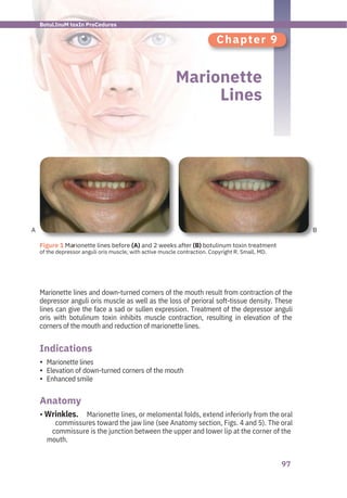 97
A B
Chapter 9
Marionette
Lines
Marionette lines
Elevation of down-turned corners of the mouth
Enhanced smile
Marionette lines and down-turned corners of the mouth result from contraction of the
depressor anguli oris muscle as well as the loss of perioral soft-tissue density. These
lines can give the face a sad or sullen expression. Treatment of the depressor anguli
oris with botulinum toxin inhibits muscle contraction, resulting in elevation of the
corners of the mouth and reduction of marionette lines.
Marionette lines, or melomental folds, extend inferiorly from the oral
commissures toward the jaw line (see Anatomy section, Figs. 4 and 5). The oral
commissure is the junction between the upper and lower lip at the corner of the
mouth.
Anatomy
Indications
•
•
•
• Wrinkles.
●
Figure 1 Marionette lines before (A) and 2 weeks after (B) botulinum toxin treatment
of the depressor anguli oris muscle, with active muscle contraction. Copyright R. Small, MD.
BotuLInuM toxIn ProCedures
 