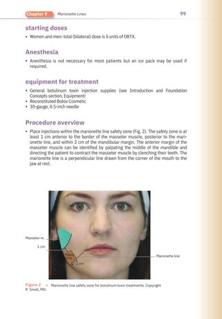 99
Chapter 9 Marionette Lines
Anesthesia
starting doses
Procedure overview
equipment for treatment
•
•
•
•
•
•
Women and men: total (bilateral) dose is 5 units of OBTX.
Anesthesia is not necessary for most patients but an ice pack may be used if
required.
Place injections within the marionette line safety zone (Fig. 2). The safety zone is at
least 1 cm anterior to the border of the masseter muscle, posterior to the mari-
onette line, and within 2 cm of the mandibular margin. The anterior margin of the
masseter muscle can be identified by palpating the middle of the mandible and
directing the patient to contract the masseter muscle by clenching their teeth. The
marionette line is a perpendicular line drawn from the corner of the mouth to the
jaw at rest.
General botulinum toxin injection supplies (see Introduction and Foundation
Concepts section, Equipment)
Reconstituted Botox Cosmetic
30-gauge, 0.5-inch needle
Figure 2 ●
R. Small, MD.
Marionette line safety zone for botulinum toxin treatments. Copyright
Masseter m.
1 cm
2 cm
Marionette line
Safety
zone
 