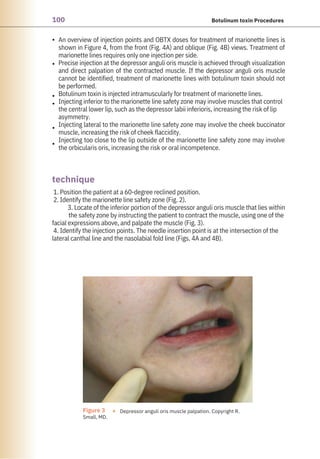 100 Botulinum toxin Procedures
•
•
•
•
•
•
1. Position the patient at a 60-degree reclined position.
2. Identify the marionette line safety zone (Fig. 2).
3. Locate of the inferior portion of the depressor anguli oris muscle that lies within
the safety zone by instructing the patient to contract the muscle, using one of the
facial expressions above, and palpate the muscle (Fig. 3).
4. Identify the injection points. The needle insertion point is at the intersection of the
lateral canthal line and the nasolabial fold line (Figs. 4A and 4B).
An overview of injection points and OBTX doses for treatment of marionette lines is
shown in Figure 4, from the front (Fig. 4A) and oblique (Fig. 4B) views. Treatment of
marionette lines requires only one injection per side.
Precise injection at the depressor anguli oris muscle is achieved through visualization
and direct palpation of the contracted muscle. If the depressor anguli oris muscle
cannot be identified, treatment of marionette lines with botulinum toxin should not
be performed.
Botulinum toxin is injected intramuscularly for treatment of marionette lines.
Injecting inferior to the marionette line safety zone may involve muscles that control
the central lower lip, such as the depressor labii inferioris, increasing the risk of lip
asymmetry.
Injecting lateral to the marionette line safety zone may involve the cheek buccinator
muscle, increasing the risk of cheek flaccidity.
Injecting too close to the lip outside of the marionette line safety zone may involve
the orbicularis oris, increasing the risk or oral incompetence.
technique
Figure 3 ●
Small, MD.
Depressor anguli oris muscle palpation. Copyright R.
 