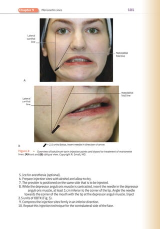 101
Chapter 9 Marionette Lines
Figure 4 ●
lines:
Overview of botulinum toxin injection points and doses for treatment of marionette
front and (B) oblique view. Copyright R. Small, MD.
(A)
>1
cm
Lateral
canthal
line
Nasolabial
fold line
B
A
Lateral
canthal
line
= 2.5 units Botox, insert needle in direction of arrow
Nasolabial
fold line
5. Ice for anesthesia (optional).
6. Prepare injection sites with alcohol and allow to dry.
7. The provider is positioned on the same side that is to be injected.
8. While the depressor anguli oris muscle is contracted, insert the needle in the depressor
anguli oris muscle, at least 1 cm inferior to the corner of the lip. Angle the needle
towards the corner of the mouth with the tip at the depressor anguli muscle. Inject
2.5 units of OBTX (Fig. 5).
9. Compress the injection sites firmly in an inferior direction.
10. Repeat this injection technique for the contralateral side of the face.
 