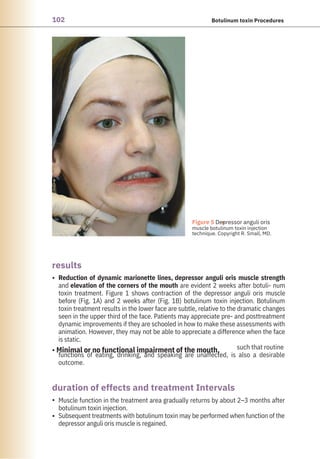 102 Botulinum toxin Procedures
results
duration of effects and treatment Intervals
•
•
•
• Minimal or no functional impairment of the mouth,
Reduction of dynamic marionette lines, depressor anguli oris muscle strength
and elevation of the corners of the mouth are evident 2 weeks after botuli- num
toxin treatment. Figure 1 shows contraction of the depressor anguli oris muscle
before (Fig. 1A) and 2 weeks after (Fig. 1B) botulinum toxin injection. Botulinum
toxin treatment results in the lower face are subtle, relative to the dramatic changes
seen in the upper third of the face. Patients may appreciate pre- and posttreatment
dynamic improvements if they are schooled in how to make these assessments with
animation. However, they may not be able to appreciate a difference when the face
is static.
such that routine
functions of eating, drinking, and speaking are unaffected, is also a desirable
outcome.
Muscle function in the treatment area gradually returns by about 2–3 months after
botulinum toxin injection.
Subsequent treatments with botulinum toxin may be performed when function of the
depressor anguli oris muscle is regained.
●
Figure 5 Depressor anguli oris
muscle botulinum toxin injection
technique. Copyright R. Small, MD.
 