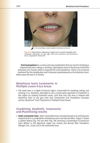 104 Botulinum toxin Procedures
The lower face is a highly functional region, responsible for speaking, eating, and
drinking. It is, therefore, advisable to use a conservative approach to treatment in
this region by rotating treatment areas, such that only one area is treated with
botulinum toxin at any give time (see Introduction and Foundation Concepts
section, Botulinum Toxin Treatments in Multiple Facial Areas).
Oral incompetence is a severe and rare complication that can result in drooling or
impaired elocution, eating, or drinking. Injecting too close to the lip may involve the
orbicularis oris muscle, which is important for oral competence. There is no corrective
treatment for this complication and it improves spontaneously as the botulinum toxin
effect wears off over 2–3 months.
Static marionette lines. Static marionette lines and downturned oral commissures
respond well to a combination of botulinum toxin and dermal fillers. Figure 7 shows
a patient before (Fig. 7A) and after (Fig. 7B) receiving a combination of botulinum
toxin (Botox) in the depressor anguli oris muscle and dermal filler (Juvederm;
Allergan, Inc., Irvine, CA) in the marionette lines.
Botulinum toxin treatments in
Multiple Lower Face Areas
Combining Aesthetic treatments
and Maximizing results
•
•
= 2.5 units Botox, insert needle in direction of arrow
●
Figure 6 Asymmetric depressor anguli oris muscle strength with
increased contraction on the right side and correction with botulinum
toxin. Copyright R. Small, MD.
 