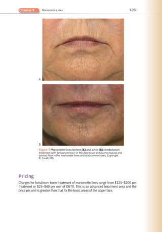 105
Chapter 9 Marionette Lines
Pricing
Charges for botulinum toxin treatment of marionette lines range from $125–$200 per
treatment or $25–$40 per unit of OBTX. This is an advanced treatment area and the
price per unit is greater than that for the basic areas of the upper face.
●
Figure 7 Marionette lines before (A) and after (B) combination
treatment with botulinum toxin in the depressor anguli oris muscle and
dermal filler in the marionette lines and oral commissures. Copyright
R. Small, MD.
A
B
 