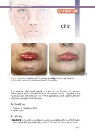 107
A B
Chapter 10
Chin
Puckered or cobblestoned chin
Mental crease
The mental crease, or labiomental crease, is a horizontal line inferior to the
lower lip (see Anatomy section, Figs. 4 and 5). The mentalis muscle has numerous
A puckered or cobblestoned appearance to the chin, and formation of a dynamic
mental crease, result from contraction of the mentalis muscle. Treatment of the
mentalis muscle with botulinum toxin inhibits contraction, which smoothes the chin
surface and reduces the mental crease.
Anatomy
Indications
•
•
• Wrinkles.
●
Figure 1 Puckered chin before (A) and 2 weeks after (B) botulinum toxin treatment
of the mentalis muscle, with active pouting. Copyright R. Small, MD.
BotulInum toxIn ProCedures
 
