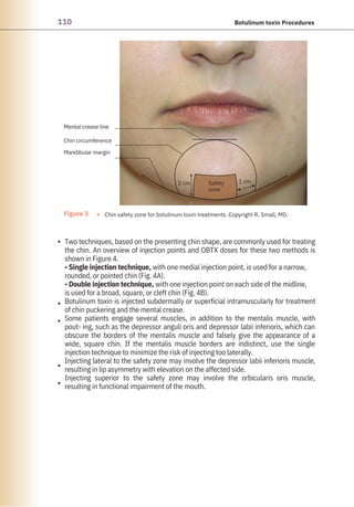 110 Botulinum toxin Procedures
•
•
•
•
•
Two techniques, based on the presenting chin shape, are commonly used for treating
the chin. An overview of injection points and OBTX doses for these two methods is
shown in Figure 4.
• Single injection technique, with one medial injection point, is used for a narrow,
rounded, or pointed chin (Fig. 4A).
• Double injection technique, with one injection point on each side of the midline,
is used for a broad, square, or cleft chin (Fig. 4B).
Botulinum toxin is injected subdermally or superficial intramuscularly for treatment
of chin puckering and the mental crease.
Some patients engage several muscles, in addition to the mentalis muscle, with
pout- ing, such as the depressor anguli oris and depressor labii inferioris, which can
obscure the borders of the mentalis muscle and falsely give the appearance of a
wide, square chin. If the mentalis muscle borders are indistinct, use the single
injection technique to minimize the risk of injecting too laterally.
Injecting lateral to the safety zone may involve the depressor labii inferioris muscle,
resulting in lip asymmetry with elevation on the affected side.
Injecting superior to the safety zone may involve the orbicularis oris muscle,
resulting in functional impairment of the mouth.
Figure 3 ● Chin safety zone for botulinum toxin treatments. Copyright R. Small, MD.
Mental crease line
Chin circumference
Mandibular margin
2 cm Safety
zone
1 cm
 