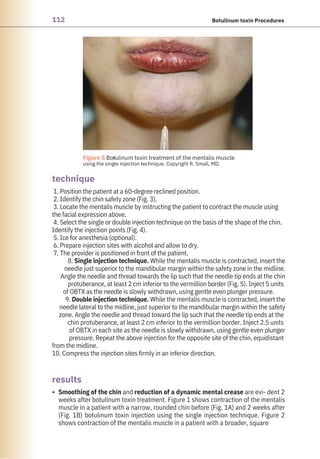 112 Botulinum toxin Procedures
results
technique
Smoothing of the chin and reduction of a dynamic mental crease are evi- dent 2
weeks after botulinum toxin treatment. Figure 1 shows contraction of the mentalis
muscle in a patient with a narrow, rounded chin before (Fig. 1A) and 2 weeks after
(Fig. 1B) botulinum toxin injection using the single injection technique. Figure 2
shows contraction of the mentalis muscle in a patient with a broader, square
1. Position the patient at a 60-degree reclined position.
2. Identify the chin safety zone (Fig. 3).
3. Locate the mentalis muscle by instructing the patient to contract the muscle using
the facial expression above.
4. Select the single or double injection technique on the basis of the shape of the chin.
Identify the injection points (Fig. 4).
5. Ice for anesthesia (optional).
6. Prepare injection sites with alcohol and allow to dry.
7. The provider is positioned in front of the patient.
8. Single injection technique. While the mentalis muscle is contracted, insert the
needle just superior to the mandibular margin within the safety zone in the midline.
Angle the needle and thread towards the lip such that the needle tip ends at the chin
protuberance, at least 2 cm inferior to the vermillion border (Fig. 5). Inject 5 units
of OBTX as the needle is slowly withdrawn, using gentle even plunger pressure.
9. Double injection technique. While the mentalis muscle is contracted, insert the
needle lateral to the midline, just superior to the mandibular margin within the safety
zone. Angle the needle and thread toward the lip such that the needle tip ends at the
chin protuberance, at least 2 cm inferior to the vermillion border. Inject 2.5 units
of OBTX in each site as the needle is slowly withdrawn, using gentle even plunger
pressure. Repeat the above injection for the opposite site of the chin, equidistant
from the midline.
10. Compress the injection sites firmly in an inferior direction.
•
●
Figure 5 Botulinum toxin treatment of the mentalis muscle
using the single injection technique. Copyright R. Small, MD.
 