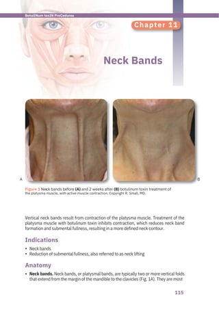115
A B
Chapter 11
Neck Bands
Neck bands
Reduction of submental fullness, also referred to as neck lifting
Vertical neck bands result from contraction of the platysma muscle. Treatment of the
platysma muscle with botulinum toxin inhibits contraction, which reduces neck band
formation and submental fullness, resulting in a more defined neck contour.
Neck bands. Neck bands, or platysmal bands, are typically two or more vertical folds
that extend from the margin of the mandible to the clavicles (Fig. 1A). They are most
Anatomy
Indications
•
•
•
●
Figure 1 Neck bands before (A) and 2 weeks after (B) botulinum toxin treatment of
the platysma muscle, with active muscle contraction. Copyright R. Small, MD.
BotulINum toxIN ProCedures
 