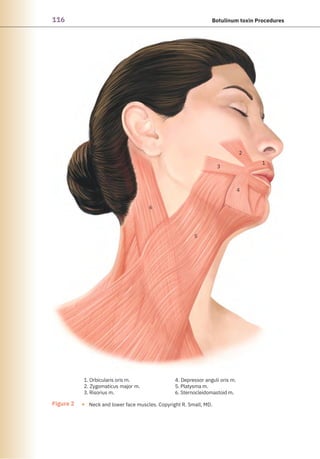 116 Botulinum toxin Procedures
1. Orbicularis oris m.
2. Zygomaticus major m.
3. Risorius m.
6
5
3
4. Depressor anguli oris m.
5. Platysma m.
6. Sternocleidomastoid m.
4
2
1
Figure 2 ● Neck and lower face muscles. Copyright R. Small, MD.
 