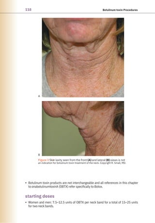 118 Botulinum toxin Procedures
A
B
●
Figure 3 Skin laxity seen from the front (A) and lateral (B) views is not
an indication for botulinum toxin treatment of the neck. Copyright R. Small, MD.
•
•
Botulinum toxin products are not interchangeable and all references in this chapter
to onabotulinumtoxinA (OBTX) refer specifically to Botox.
Women and men: 7.5–12.5 units of OBTX per neck band for a total of 15–25 units
for two neck bands.
starting doses
 
