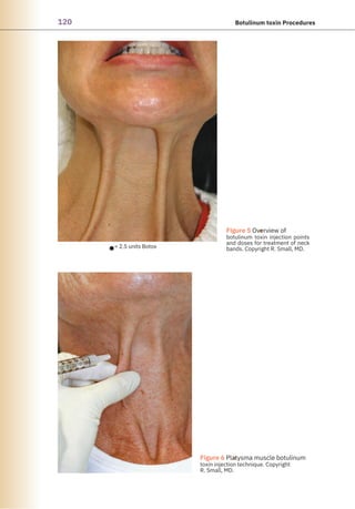 120 Botulinum toxin Procedures
●
●
Figure 5 Overview of
botulinum toxin injection points
and doses for treatment of neck
bands. Copyright R. Small, MD.
Figure 6 Platysma muscle botulinum
toxin injection technique. Copyright
R. Small, MD.
= 2.5 units Botox
 