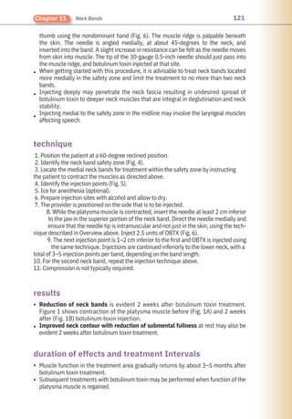 121
Chapter 11 Neck Bands
Reduction of neck bands is evident 2 weeks after botulinum toxin treatment.
Figure 1 shows contraction of the platysma muscle before (Fig. 1A) and 2 weeks
after (Fig. 1B) botulinum toxin injection.
Improved neck contour with reduction of submental fullness at rest may also be
evident 2 weeks after botulinum toxin treatment.
thumb using the nondominant hand (Fig. 6). The muscle ridge is palpable beneath
the skin. The needle is angled medially, at about 45-degrees to the neck, and
inserted into the band. A slight increase in resistance can be felt as the needle moves
from skin into muscle. The tip of the 30-gauge 0.5-inch needle should just pass into
the muscle ridge, and botulinum toxin injected at that site.
When getting started with this procedure, it is advisable to treat neck bands located
more medially in the safety zone and limit the treatment to no more than two neck
bands.
Injecting deeply may penetrate the neck fascia resulting in undesired spread of
botulinum toxin to deeper neck muscles that are integral in deglutination and neck
stability.
Injecting medial to the safety zone in the midline may involve the laryngeal muscles
affecting speech.
Muscle function in the treatment area gradually returns by about 3–5 months after
botulinum toxin treatment.
Subsequent treatments with botulinum toxin may be performed when function of the
platysma muscle is regained.
1. Position the patient at a 60-degree reclined position.
2. Identify the neck band safety zone (Fig. 4).
3. Locate the medial neck bands for treatment within the safety zone by instructing
the patient to contract the muscles as directed above.
4. Identify the injection points (Fig. 5).
5. Ice for anesthesia (optional).
6. Prepare injection sites with alcohol and allow to dry.
7. The provider is positioned on the side that is to be injected.
8. While the platysma muscle is contracted, insert the needle at least 2 cm inferior
to the jaw in the superior portion of the neck band. Direct the needle medially and
ensure that the needle tip is intramuscular and not just in the skin, using the tech-
nique described in Overview above. Inject 2.5 units of OBTX (Fig. 6).
9. The next injection point is 1–2 cm inferior to the first and OBTX is injected using
the same technique. Injections are continued inferiorly to the lower neck, with a
total of 3–5 injection points per band, depending on the band length.
10. For the second neck band, repeat the injection technique above.
11. Compression is not typically required.
•
•
•
•
•
•
•
results
technique
duration of effects and treatment Intervals
 