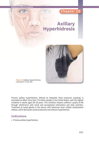 125
●
Figure 1 Axillary hyperhidrosis.
Copyright R. Small, MD.
Chapter 12
Axillary
Hyperhidrosis
Primary axillary hyperhidrosis
Primary axillary hyperhidrosis, defined as idiopathic focal excessive sweating, is
estimated to affect more than 7.8 million people in the United States, with the highest
incidence in adults aged 18–54 years. This condition impacts sufferers’ quality of life
through interference with social and occupational interactions and daily activities.
Treatment of sweat glands in the dermis with botulinum toxin inhibits acetylcholine
release, which decreases sweat production and reduces hyperhidrosis.
Indications
•
BotulInum toxIn ProCedures
 